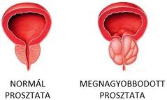 prosztata díj a prostatitis megelőzése érdekében